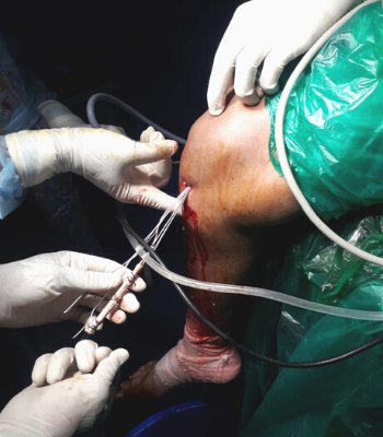 Shoulder and knee arthroscopy in Aurangabad